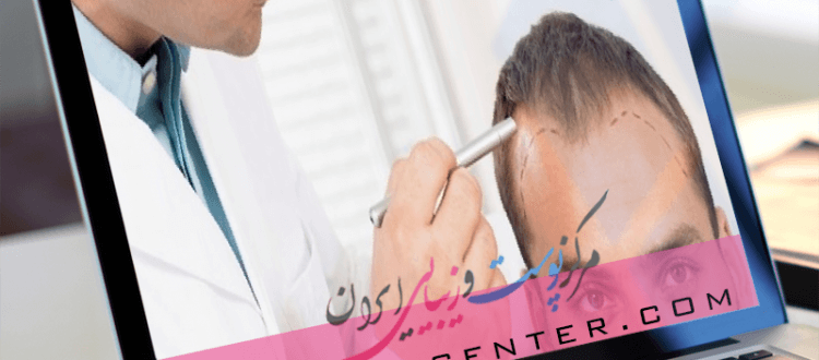 انواع روش های کاشت مو و مناسب ترین روش در بین آنها